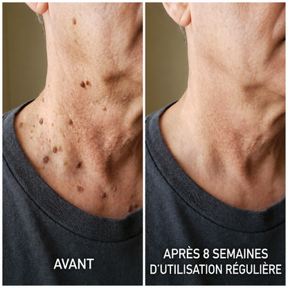 Crème kératolytique pour les kératoses séborrhéiques